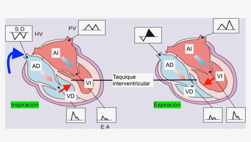 Influencia de la inspiración en el llenado del ventrículo derecho y el desplazamiento del tabique.