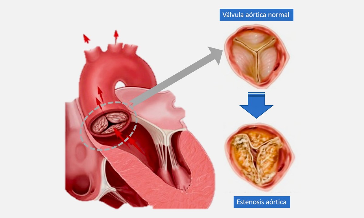 Estenosis aórtica: una enfermedad más frecuente de lo que se&nbsp;pensaba