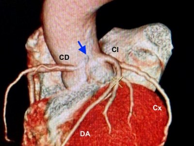 Origen anómalo de la arteria coronaria derecha: una amenaza de infarto y muerte súbita con solución&nbsp;quirúrgica