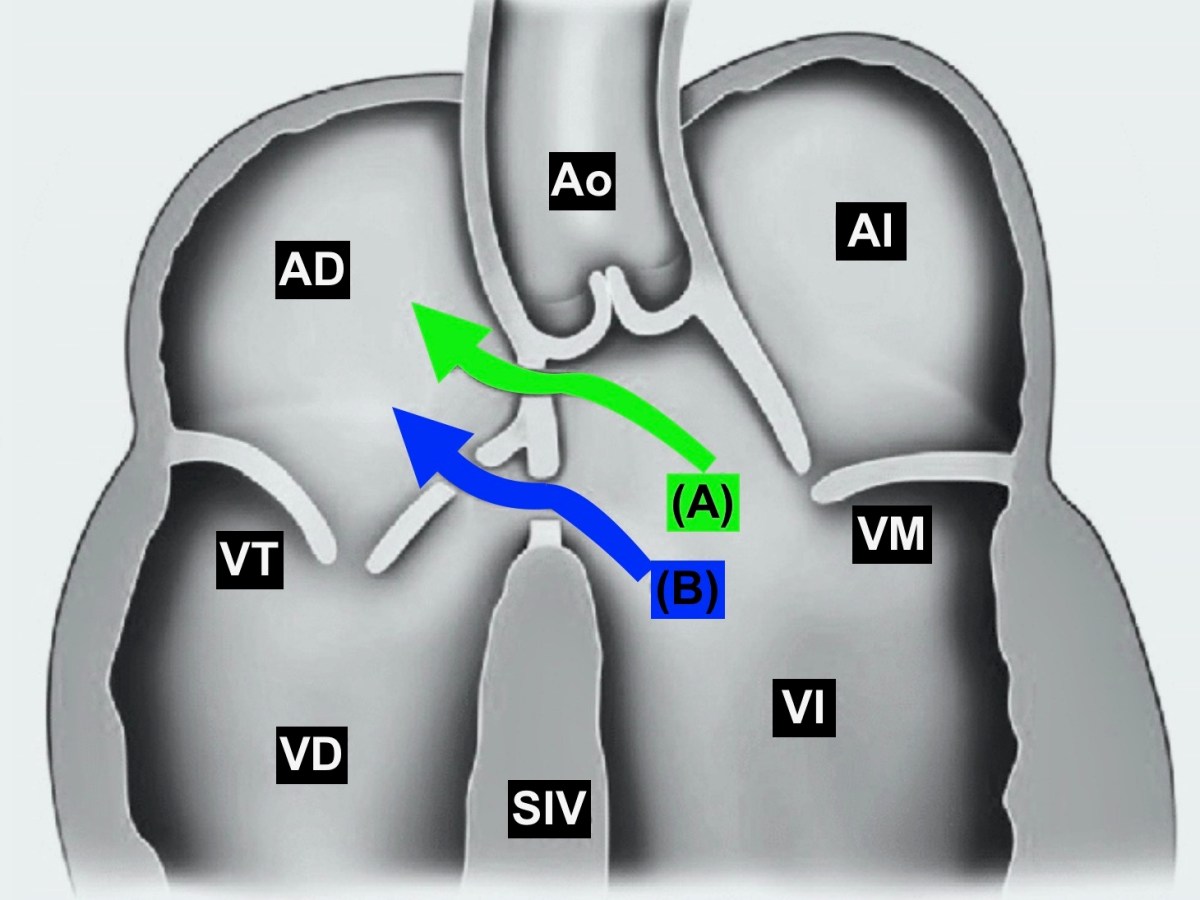 Corrección quirúrgica de un defecto septal tipo Gerbode secundario a endocarditis&nbsp;aórtica